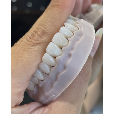 活动义齿; 固定义齿; 假牙加工; 烤瓷牙; 二氧化锆; 贵金属烤瓷牙; 大小支架; 隐  厂家直销图3