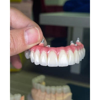 深圳种植牙外贸义齿公司 全口种植马龙桥图2