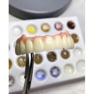 深圳种植牙外贸义齿公司 全口种植马龙桥图4