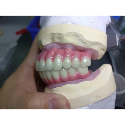 种植牙马龙桥生产厂家 （Maryland Bridge）图2