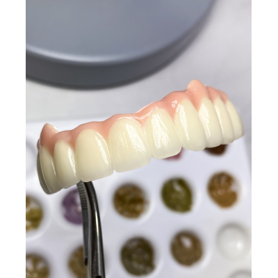 种植牙马龙桥生产厂家 （Maryland Bridge）图4