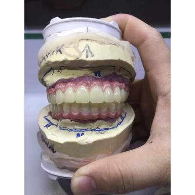 深圳义齿种植牙厂家 发货全球 通过FDA 认证 义齿加工厂图3