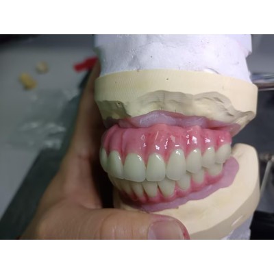 Full Denture Implants图3