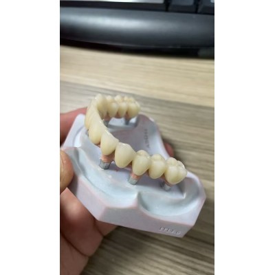 Full Denture Implants图2